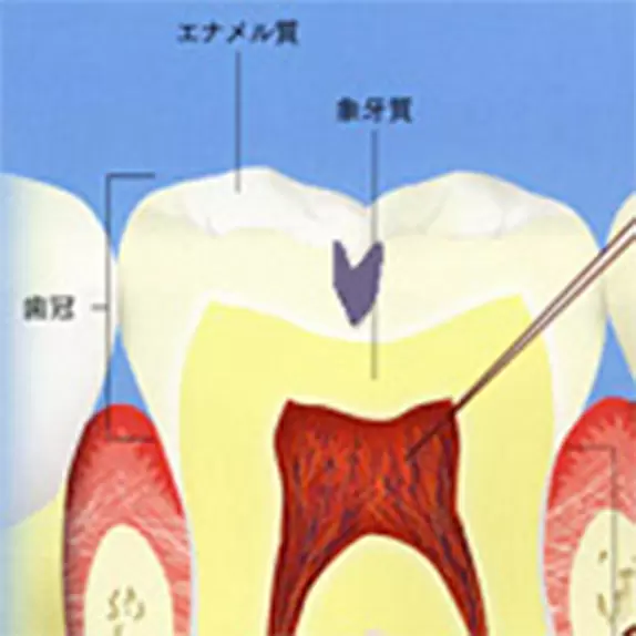 できたばかりのむし歯