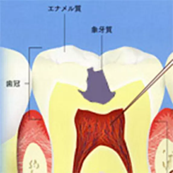 ぞうげ質まで穴が開いたむし歯