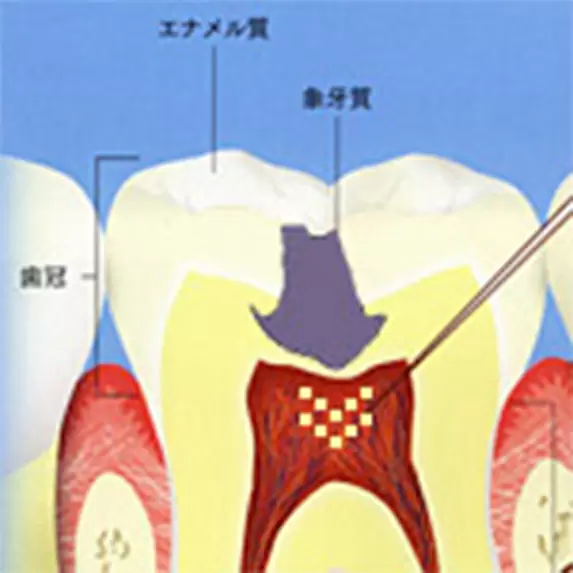 歯ずいまで進んだむし歯