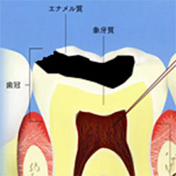 さらにむし歯が進んだ状態
