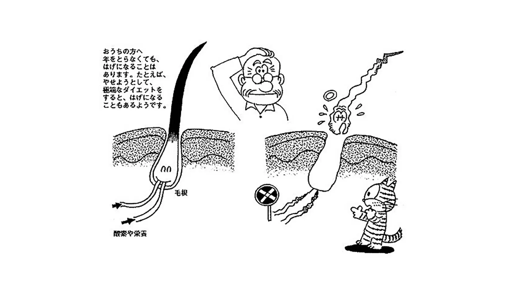 どうして(としをとると）はげるの