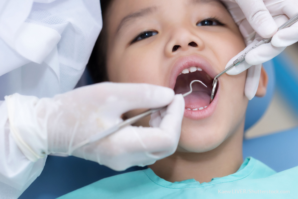 学校歯科検診「斜線・CO」の記号の意味は？子どものむし歯の原因と仕組み【専門医が解説】