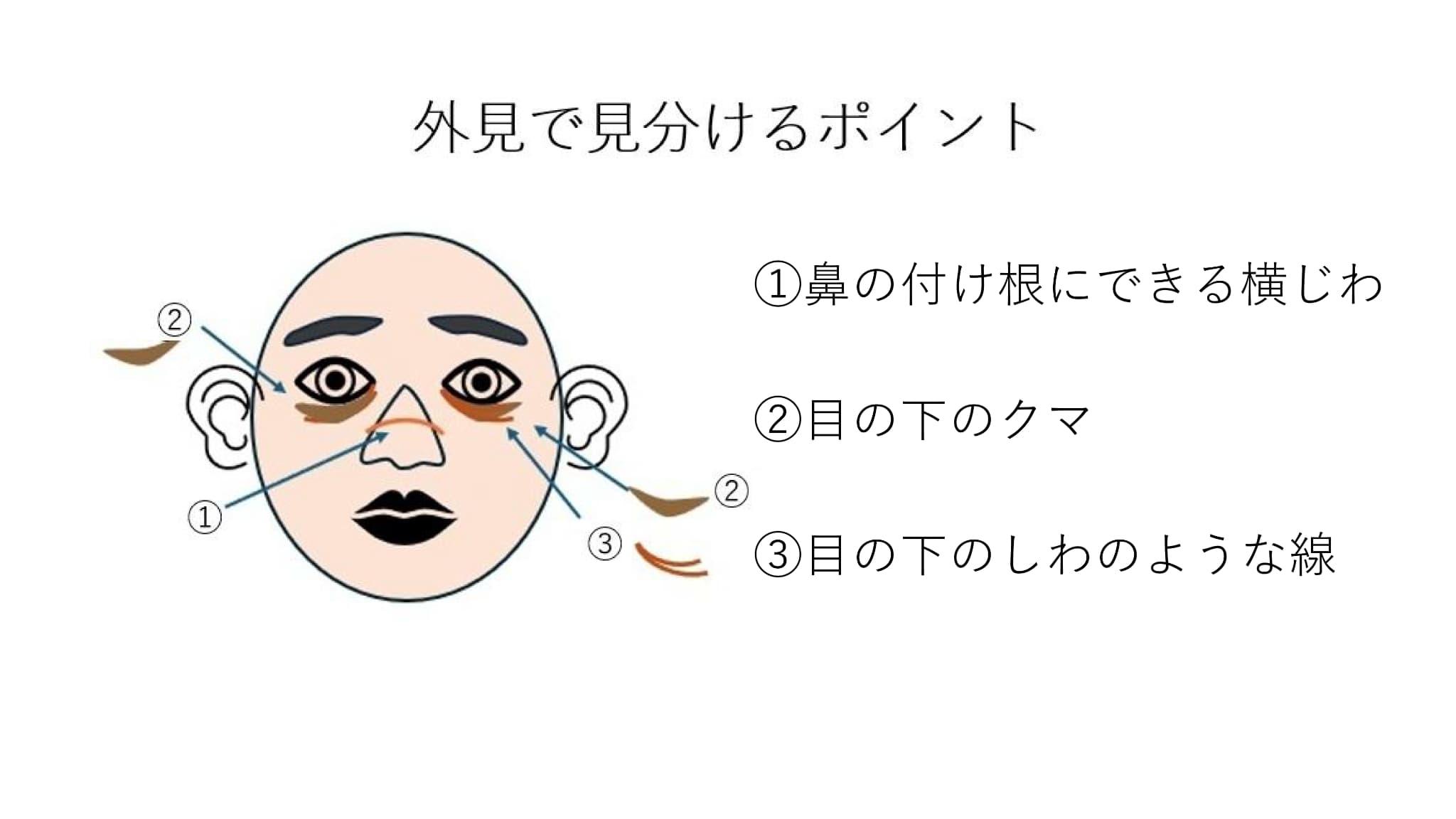 花粉症によるアレルギー性鼻炎を外見で見分けるポイント図解