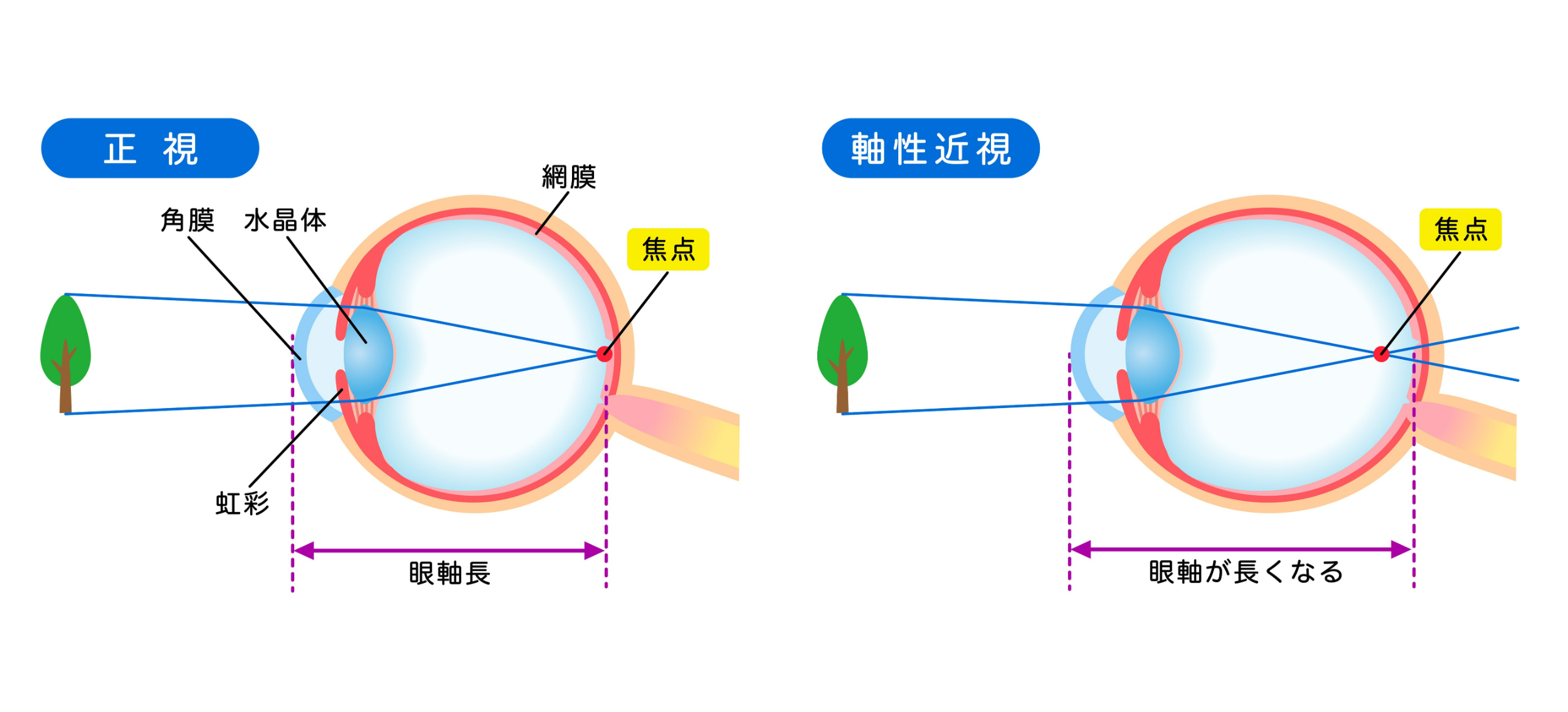 正視と軸性近視
