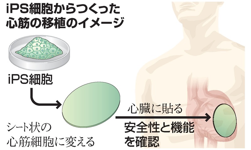 iPS細胞からつくった心筋の移植のイメージ図解