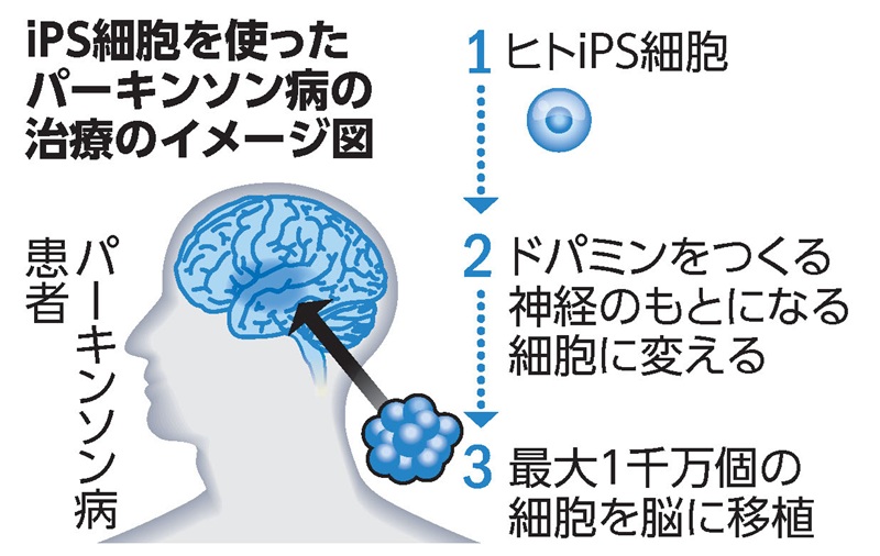 iPS細胞を使ったパーキンソン病の治療のイメージ図